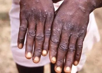 TVHB Başkanı Eroğlu: “Maymun çiçeğine karşı aşı var”