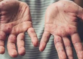 Bayram öncesi uzmanlardan ‘maymun çiçeği’ uyarısı!